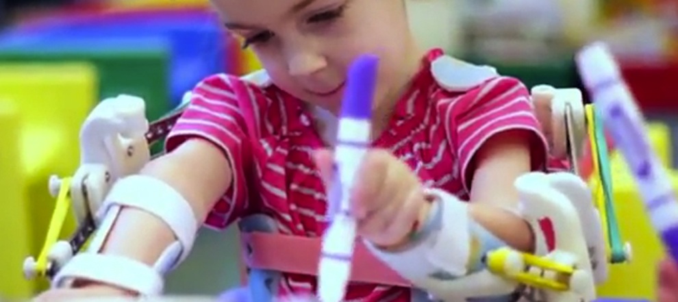 4-årig har fået printet nye arme